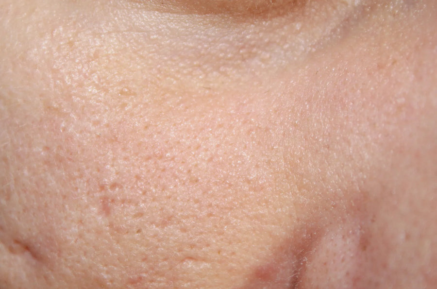 Macro de la joue montrant la texture de peau et des pores dilatés en lumière naturelle — CAMENYS