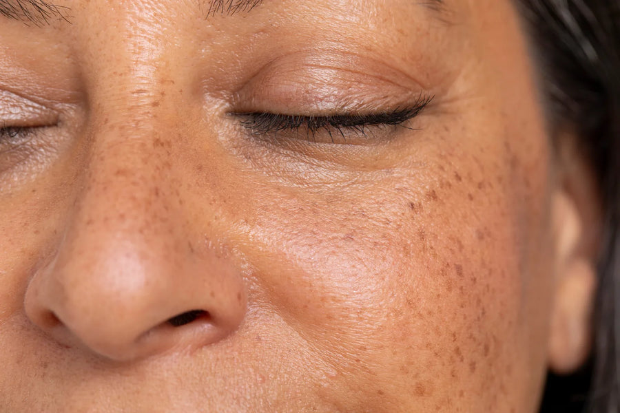 Gros plan du contour de l'œil et de la joue montrant une pigmentation brune sous lumière naturelle chaude